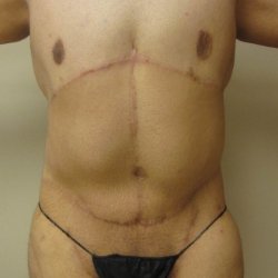 Manhattan abdominoplasty after 15